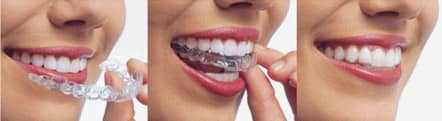 Clear Aligners Treatments For Teeth in Delhi,South Delhi, Greater Kailash