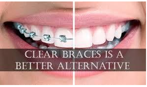 clear-aligners-2