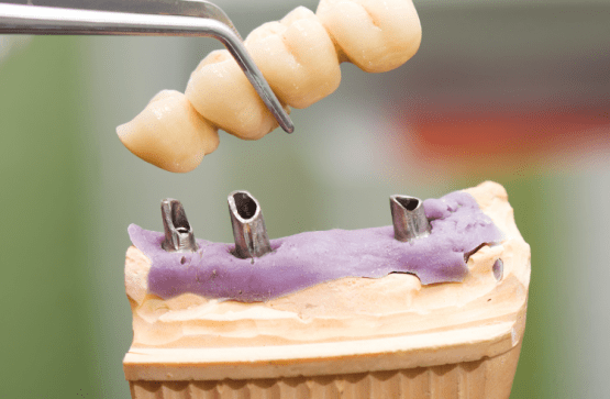 Crown Dental Treatment
