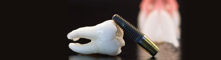 Dental Implants Treatment