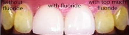 Fluoride Therapy