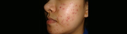 acne treatment in Delhi