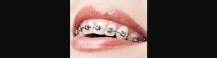 Metal or fixed Braces Treatment in Delhi,South Delhi, Greater Kailash 