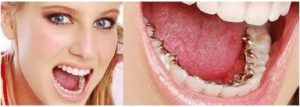 Orthodontic Lingual Braces Treatment in Delhi, South Delhi, Greater Kailash