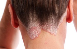 Psoriasis cure treatment