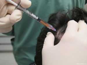 Cost of PRP Hair Treatment in Delhi for Hair Fall | PRP Therapy in Delhi,  South Delhi, Greater Kailash