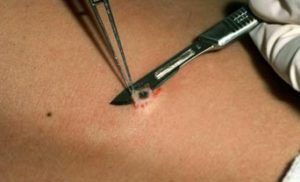 How Much Does A Skin Biopsy Cost?  