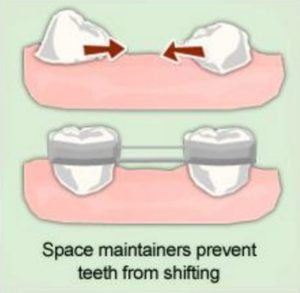 Tooth Space Maintainers for kids in Delhi, South Delhi, Greater kailash